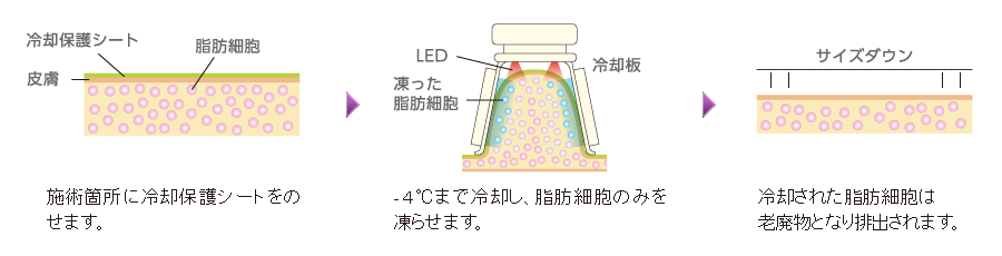 脂肪冷却とは？