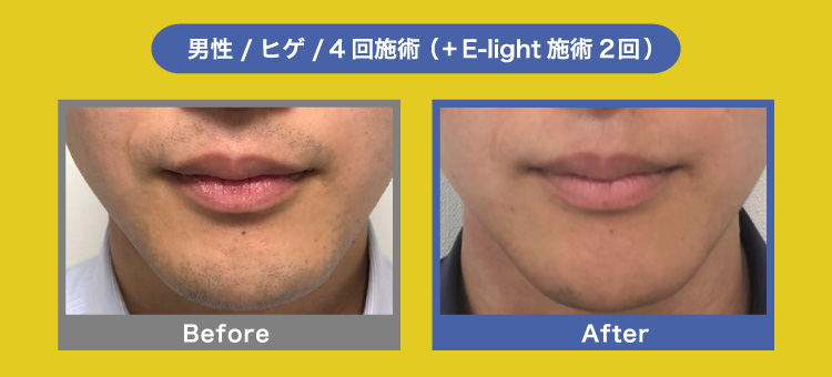 男性/ヒゲ/4回施術 Before After