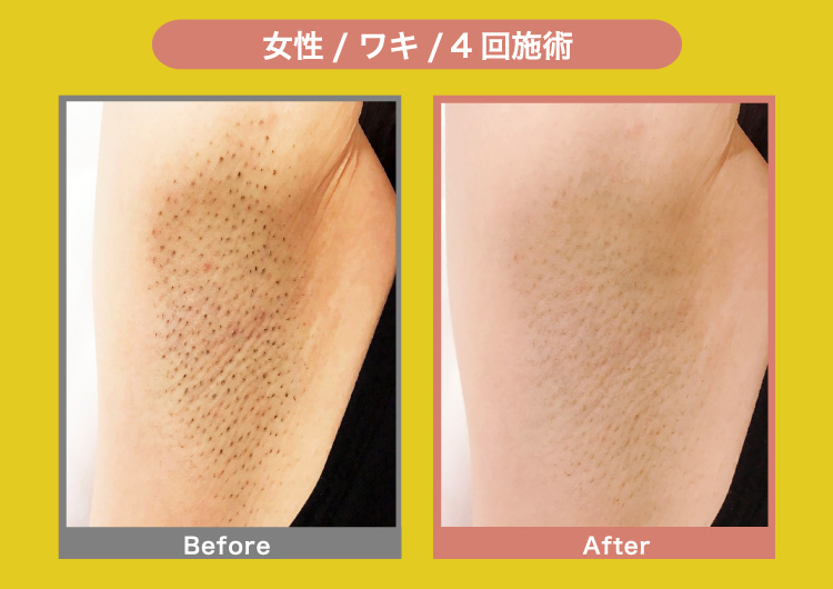 女性/ワキ/4回施術 Before After