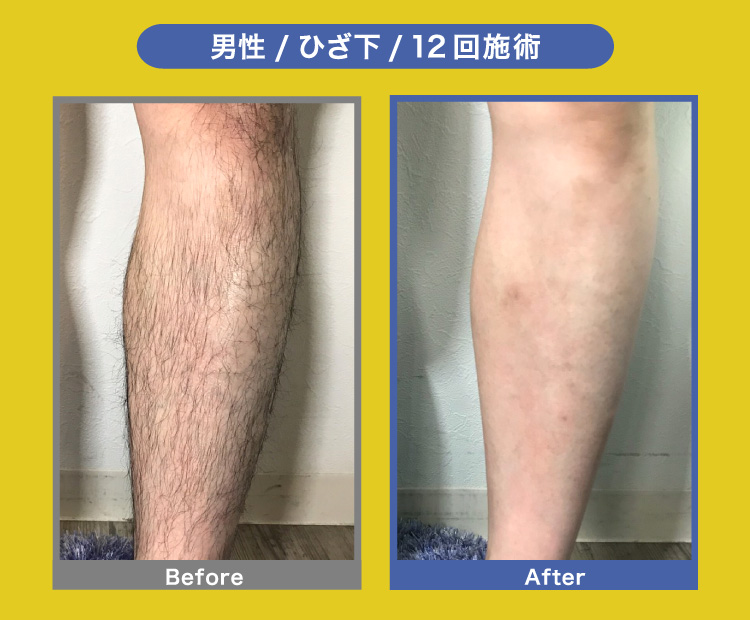 男性/ひざ下/12回施術 Before After