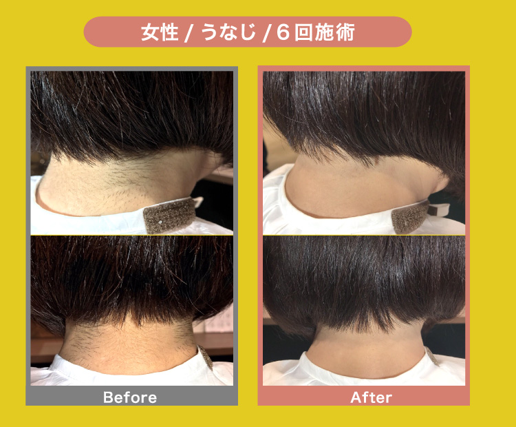 女性/うなじ/6回施術 Before After