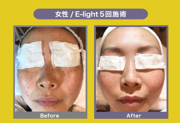 女性/E-light/6回施術 Before After