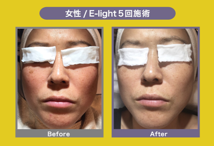 女性/E-light/5回施術 Before After