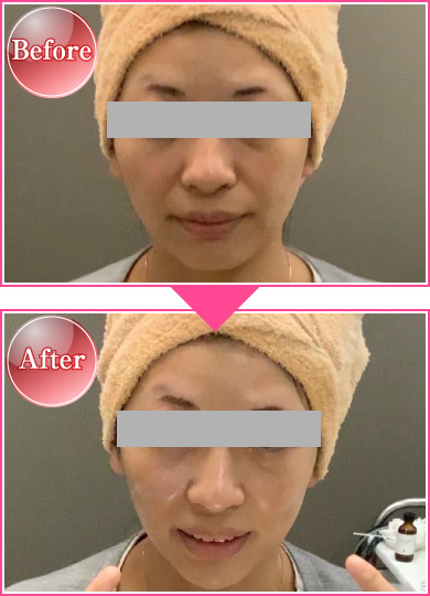 ホワイトスノーピールコース 施術事例